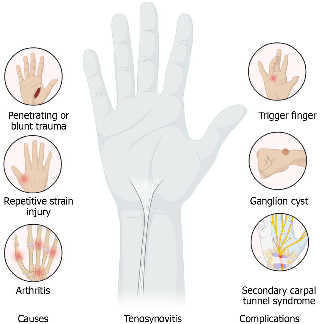 Sheathing Injury 5024 - Tenosynovitis, tendinitis, tendinosis or tendinopathy | MEPSS | Medi