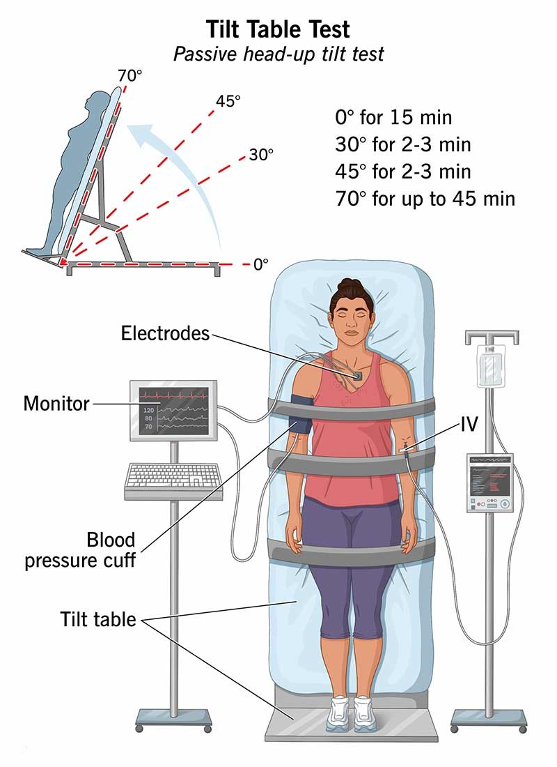 7009 Bradycardia Bradyarrhythmia Symptomatic Requiring Permanent Pace 7009 Bradycardia Bradyarrhythmia Symptomatic Requiring Permanent Pace